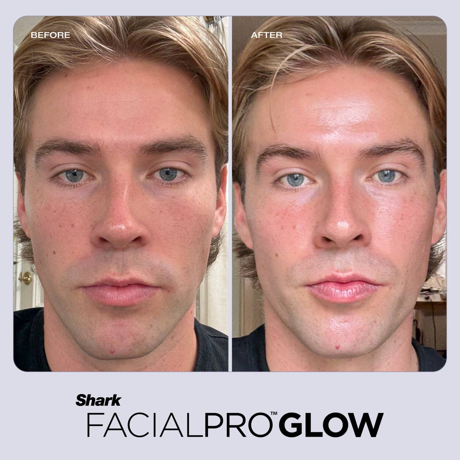 Shark FacialPro Glow At Home Hydro-Powered System - Blue Shark FacialPro Glow At Home Hydro-Powered System - Blue